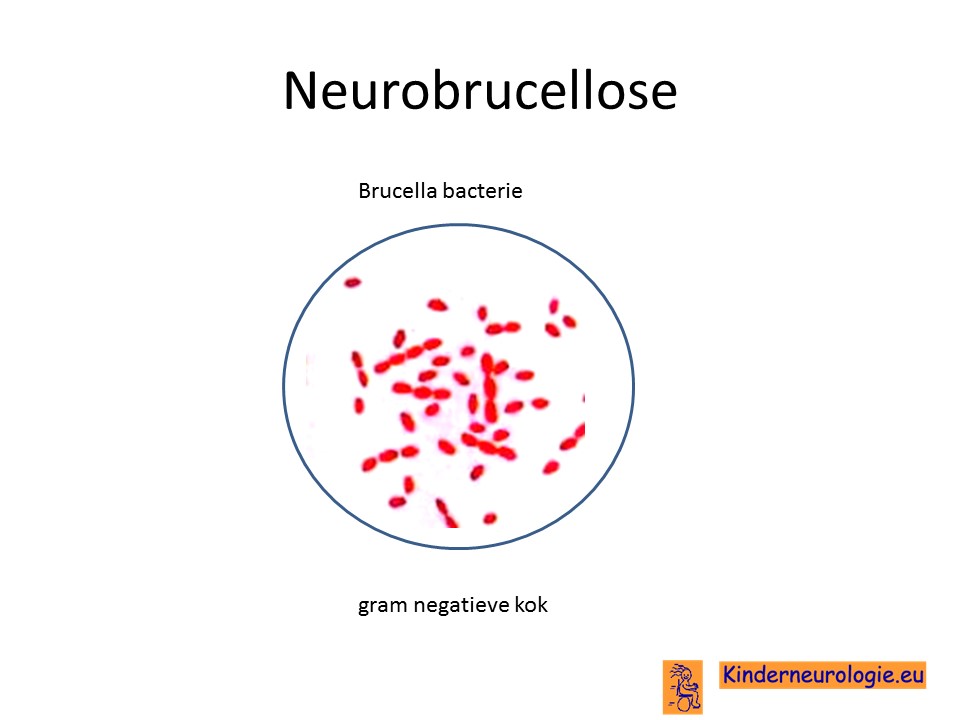 Neurobrucellose