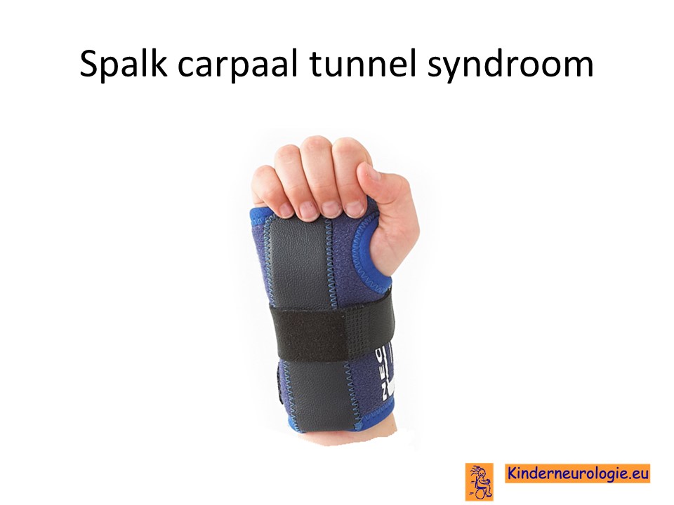 bedrag studie Onbepaald Carpaal tunnel syndroom